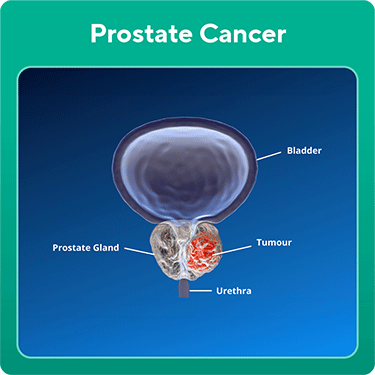 Prostate Cancer image