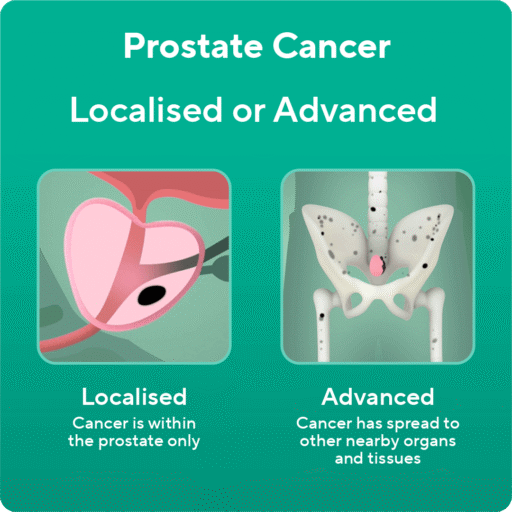 Prostate Cancer: Localised or Advanced