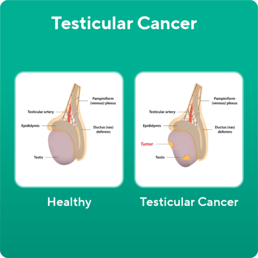 Testicular Cancer image